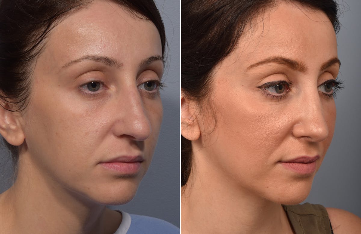 Rhinoplasty Before & After Gallery - Patient 110870 - Image 4