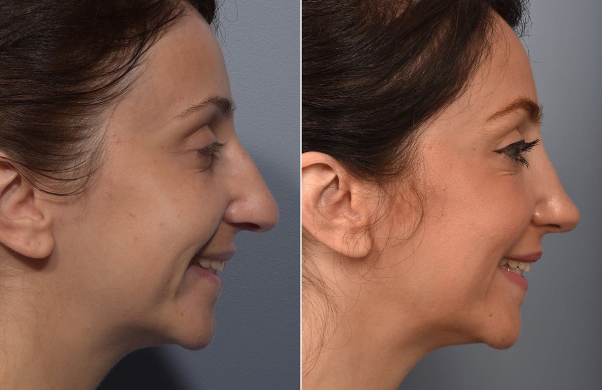 Rhinoplasty Before & After Gallery - Patient 110870 - Image 1