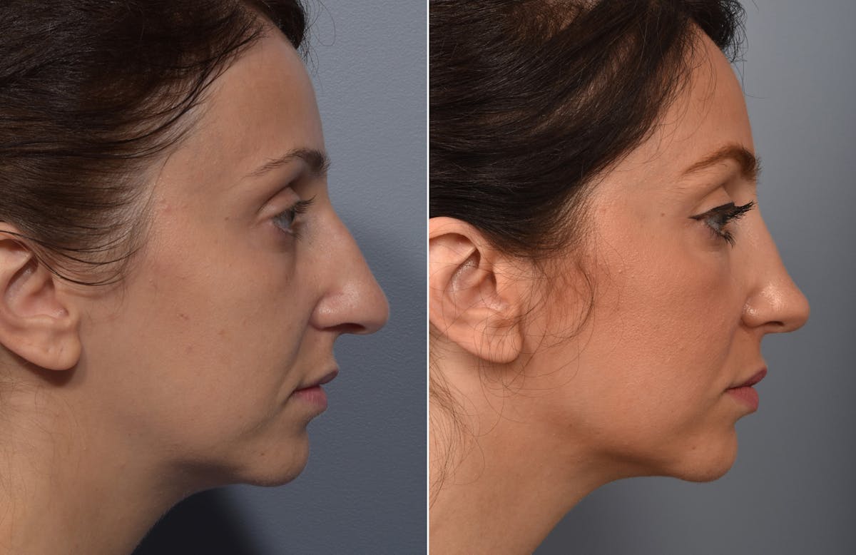 Rhinoplasty Before & After Gallery - Patient 110870 - Image 2