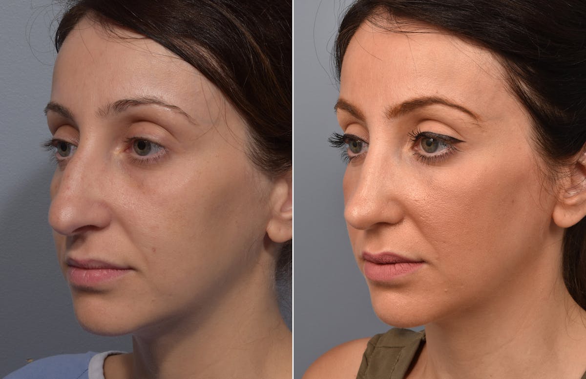 Rhinoplasty Before & After Gallery - Patient 110870 - Image 5