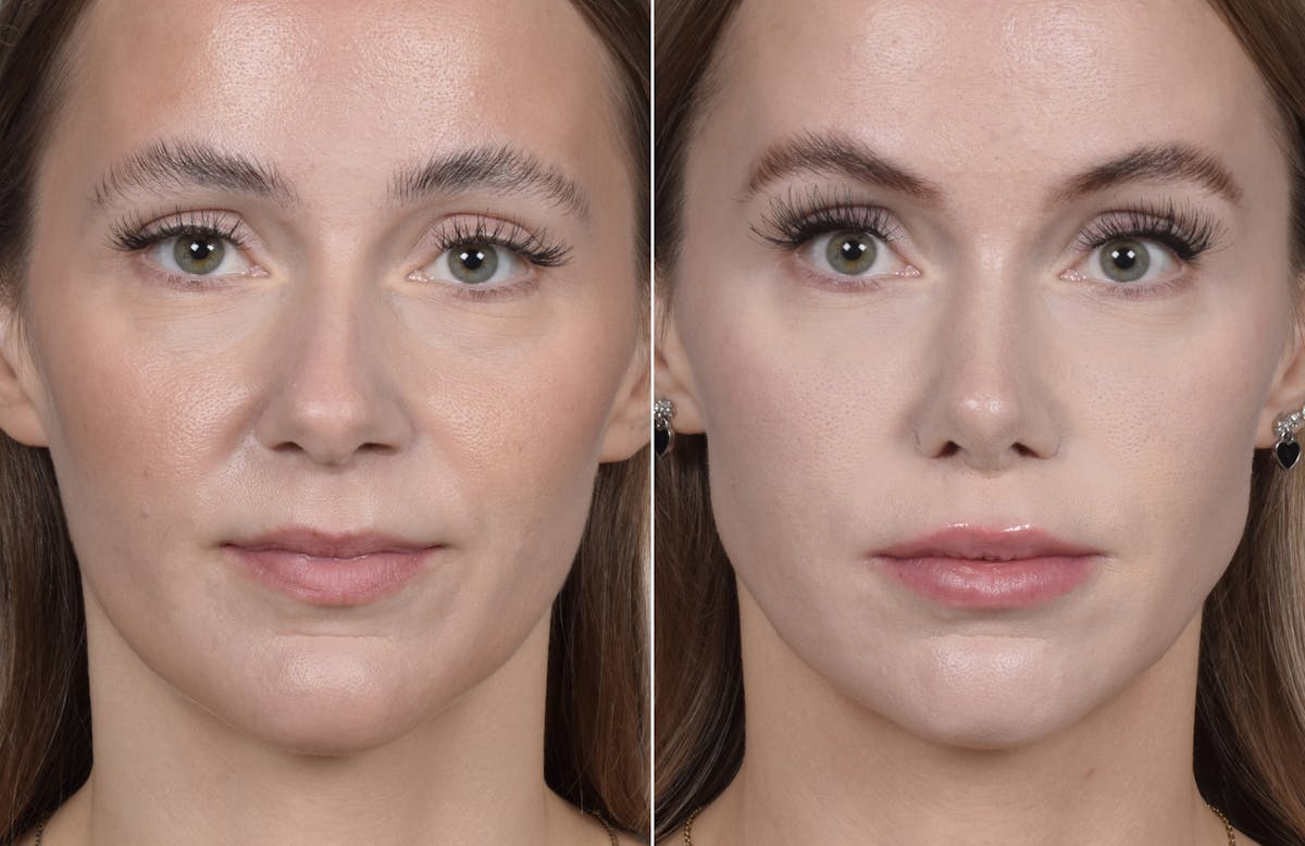 Rhinoplasty Before & After Gallery - Patient 641641 - Image 6