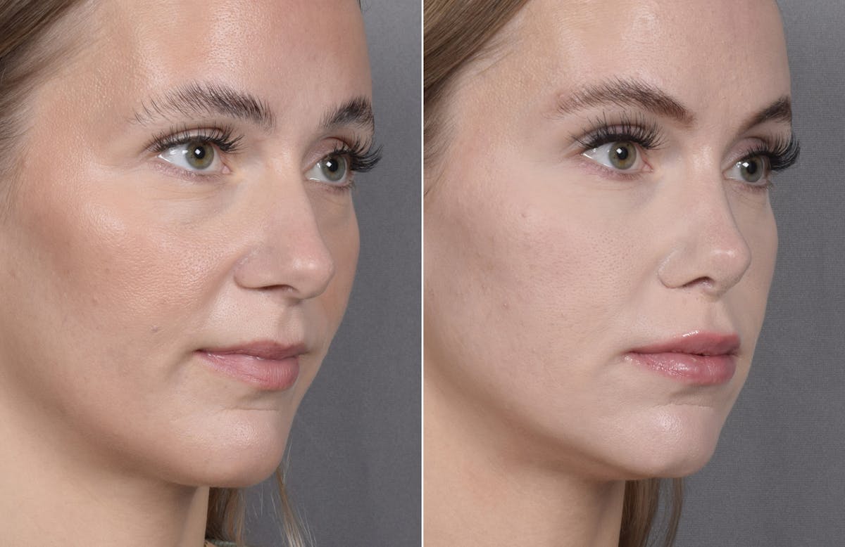 Rhinoplasty Before & After Gallery - Patient 641641 - Image 3