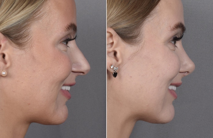 Rhinoplasty Before & After Gallery - Patient 641641 - Image 1