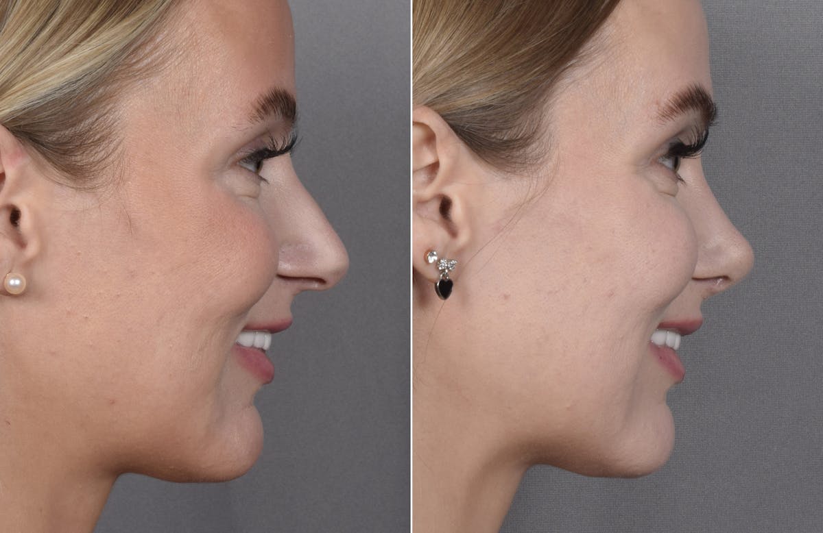 Rhinoplasty Before & After Gallery - Patient 641641 - Image 1