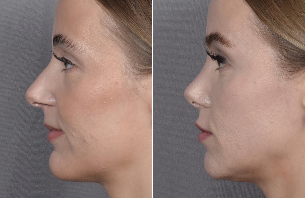 Rhinoplasty Before & After Gallery - Patient 641641 - Image 4