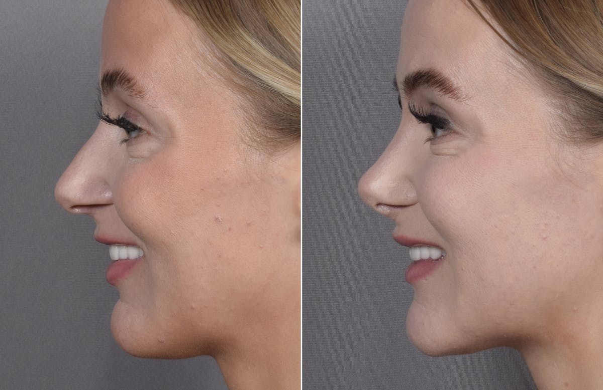 Rhinoplasty Before & After Gallery - Patient 641641 - Image 5