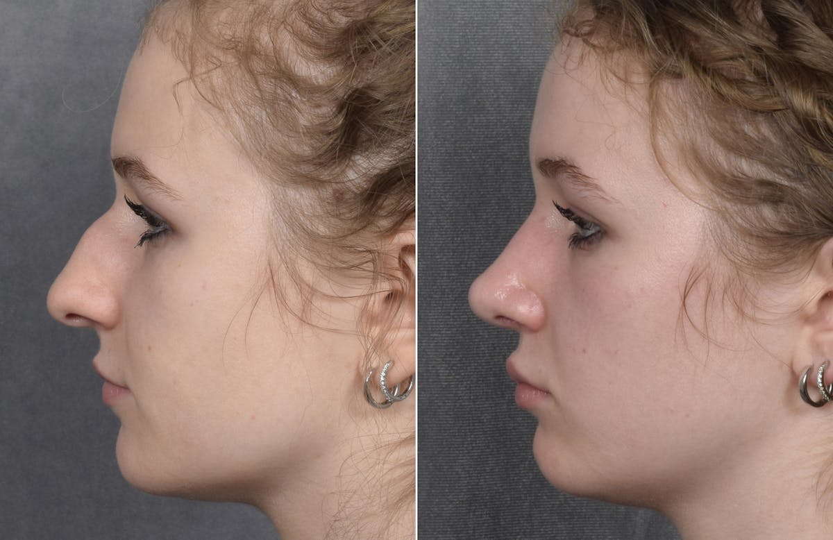 Rhinoplasty Before & After Gallery - Patient 102079 - Image 7