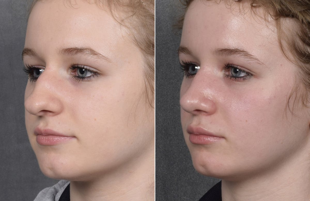 Rhinoplasty Before & After Gallery - Patient 102079 - Image 6