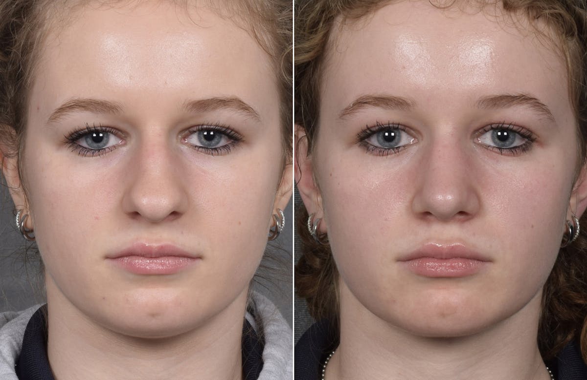 Rhinoplasty Before & After Gallery - Patient 102079 - Image 3