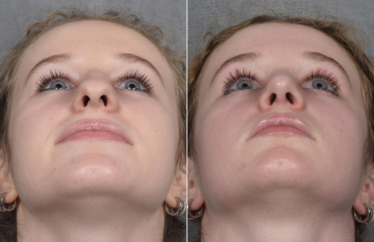 Rhinoplasty Before & After Gallery - Patient 102079 - Image 4