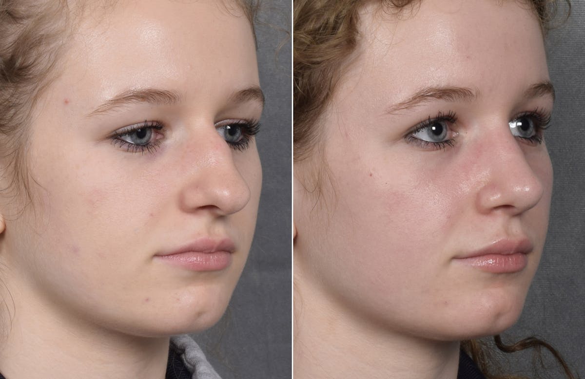 Rhinoplasty Before & After Gallery - Patient 102079 - Image 5