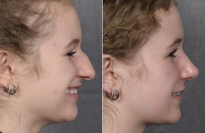 Rhinoplasty Before & After Gallery - Patient 102079 - Image 1