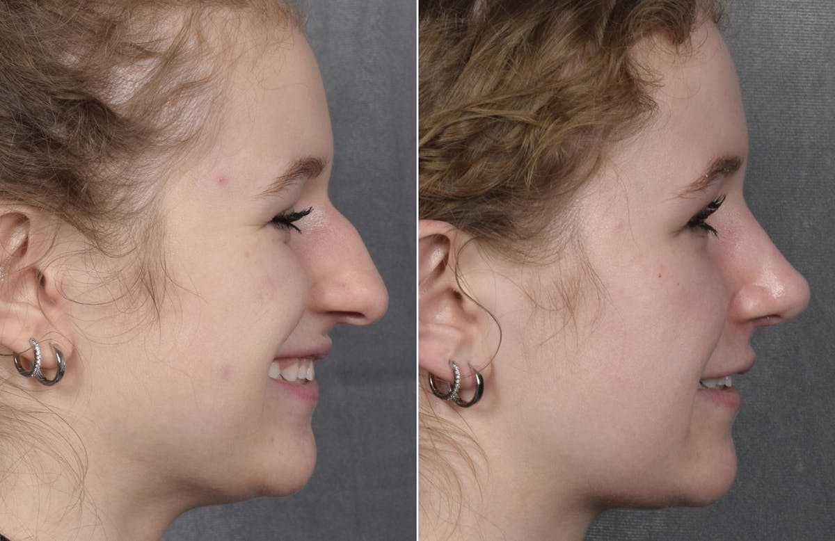 Rhinoplasty Before & After Gallery - Patient 102079 - Image 1