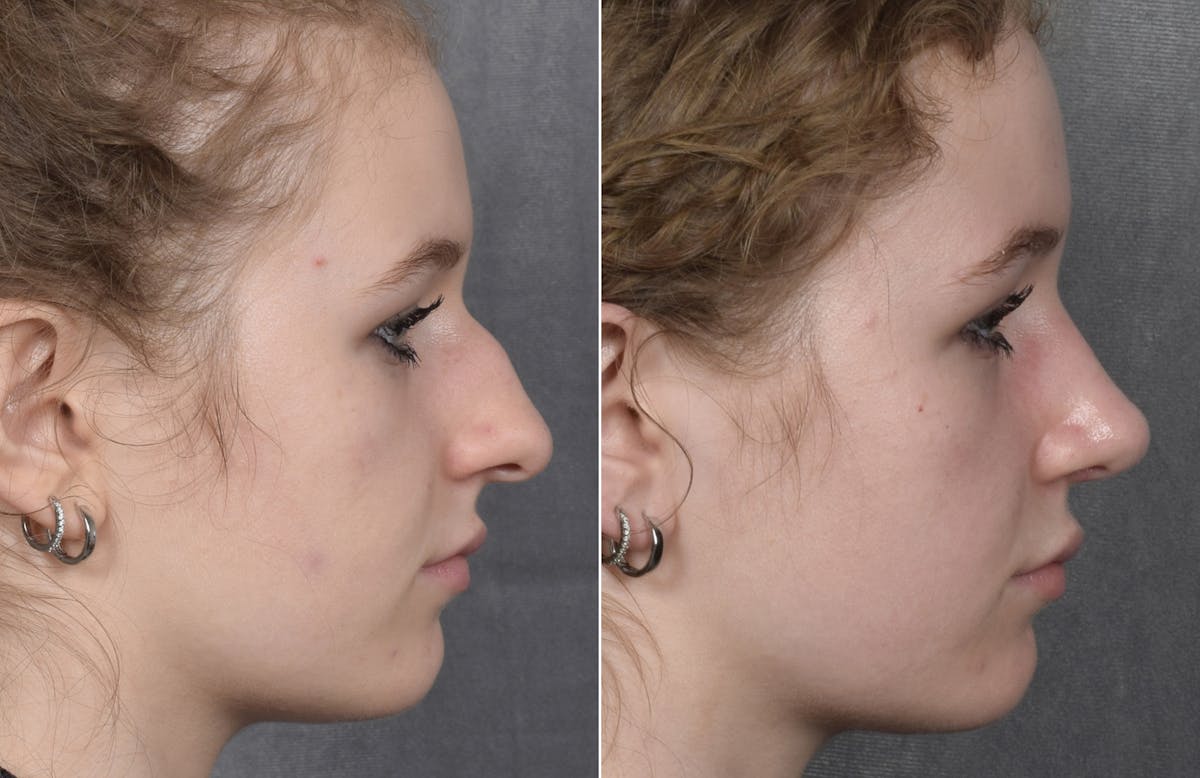 Rhinoplasty Before & After Gallery - Patient 102079 - Image 2