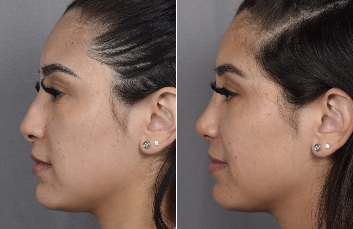 Rhinoplasty Before & After Gallery - Patient 230343 - Image 6