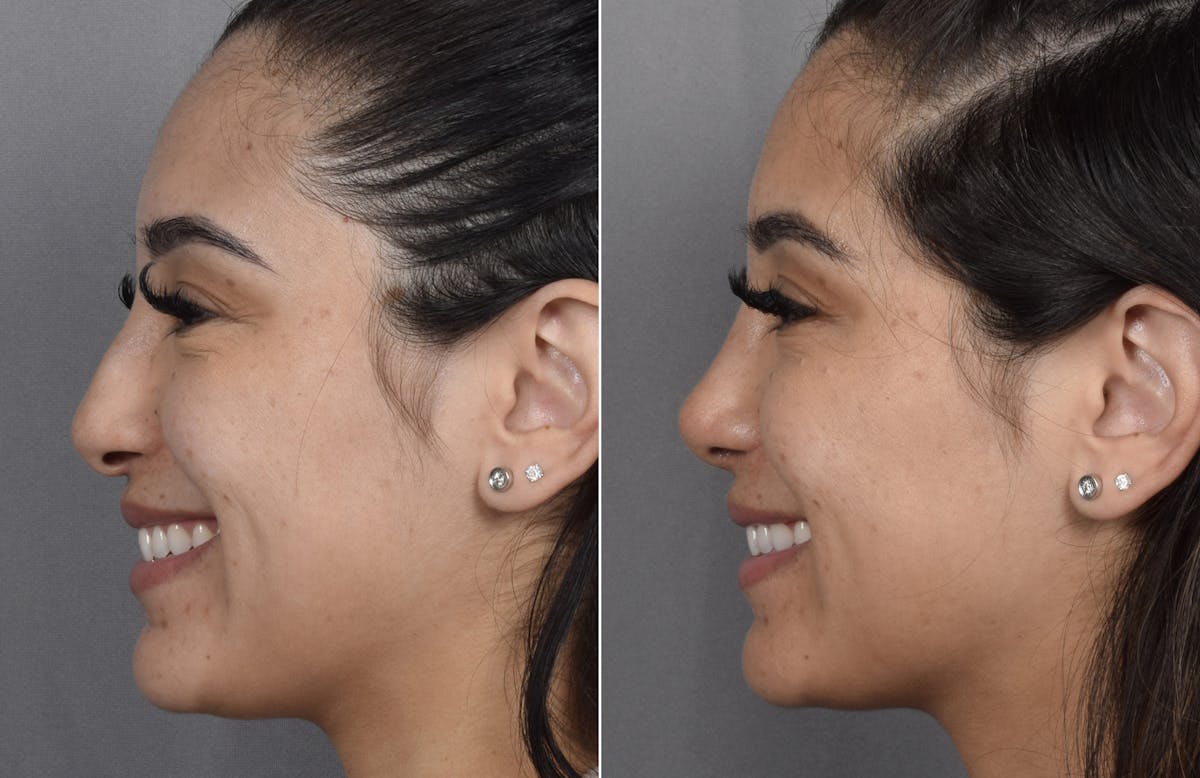 Rhinoplasty Before & After Gallery - Patient 230343 - Image 7