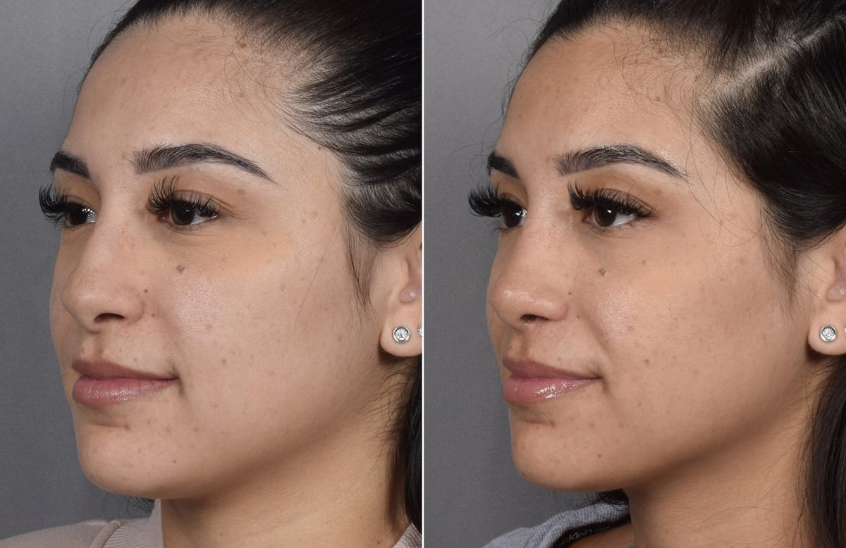 Rhinoplasty Before & After Gallery - Patient 230343 - Image 5