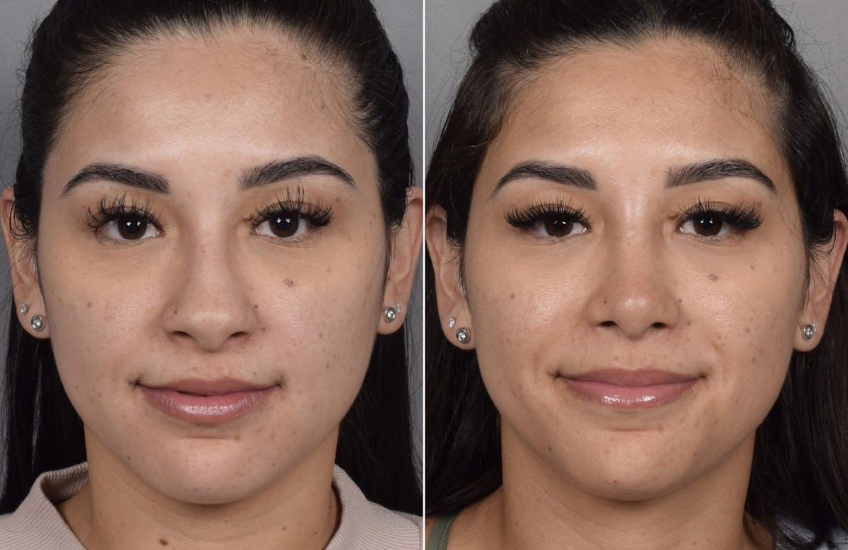 Rhinoplasty Before & After Gallery - Patient 230343 - Image 3