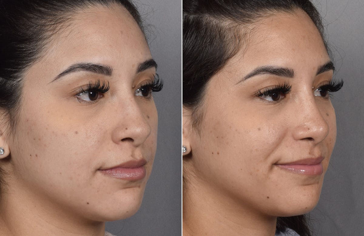 Rhinoplasty Before & After Gallery - Patient 230343 - Image 4