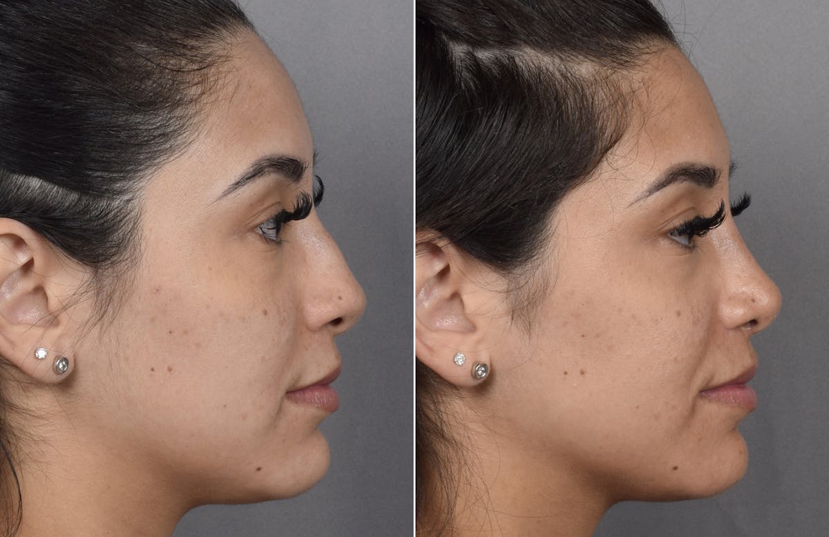 Rhinoplasty Before & After Gallery - Patient 230343 - Image 2