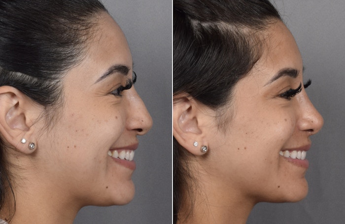 Rhinoplasty Before & After Gallery - Patient 230343 - Image 1