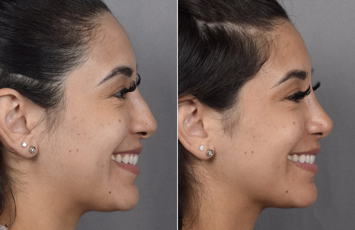 Rhinoplasty Before & After Gallery - Patient 230343 - Image 1