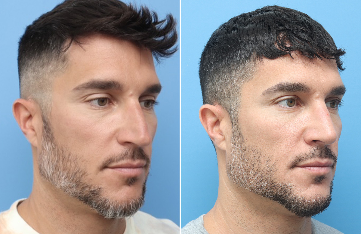 Rhinoplasty Before & After Gallery - Patient 264447 - Image 3