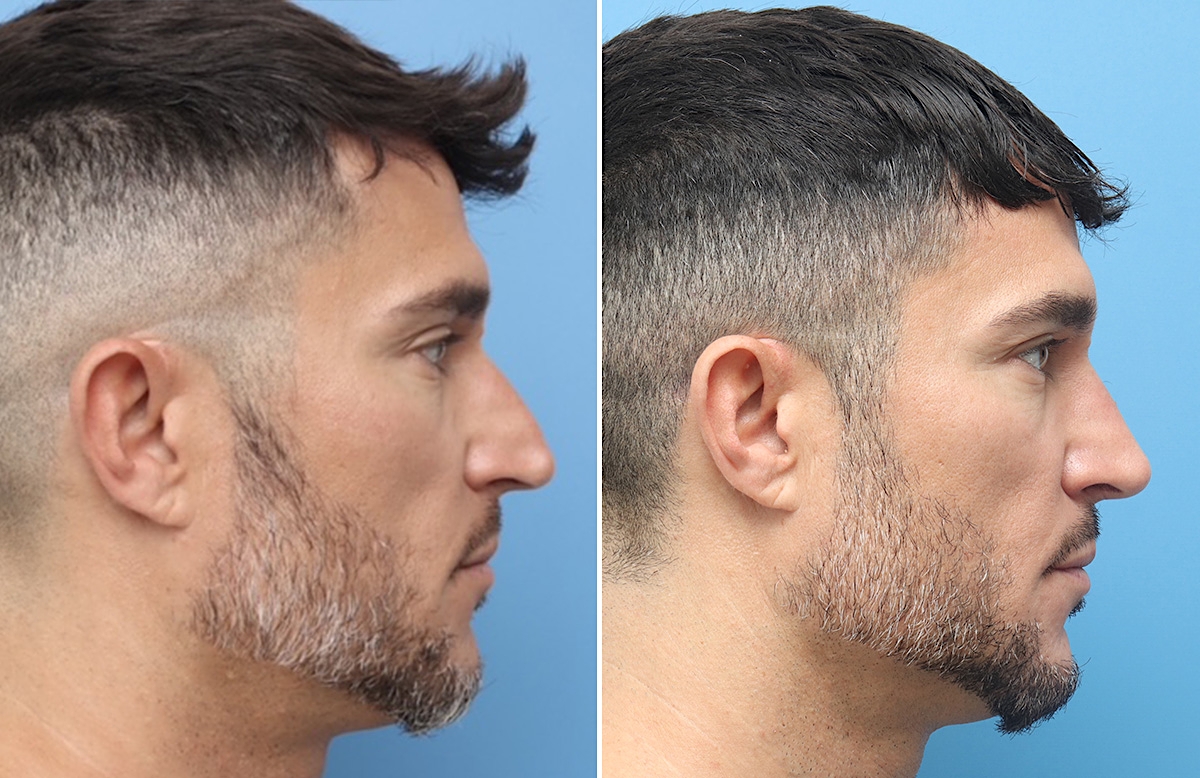 Rhinoplasty Before & After Gallery - Patient 264447 - Image 2