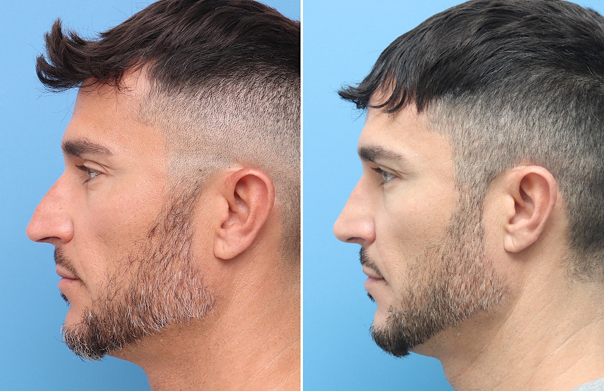 Rhinoplasty Before & After Gallery - Patient 264447 - Image 6