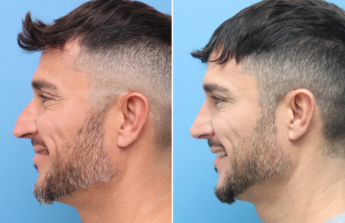 Rhinoplasty Before & After Gallery - Patient 264447 - Image 7