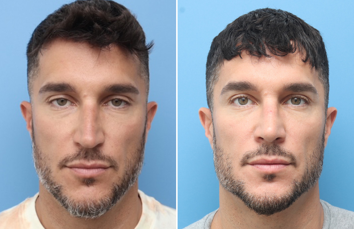 Rhinoplasty Before & After Gallery - Patient 264447 - Image 4