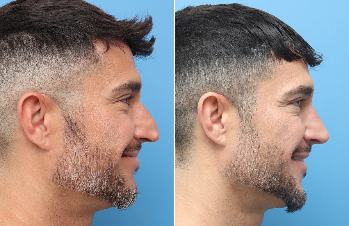 Rhinoplasty Before & After Gallery - Patient 264447 - Image 1