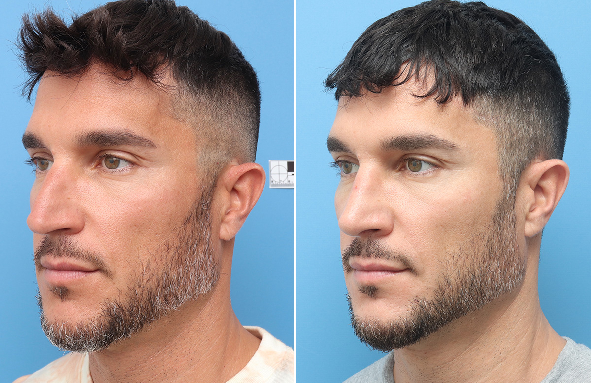 Rhinoplasty Before & After Gallery - Patient 264447 - Image 5