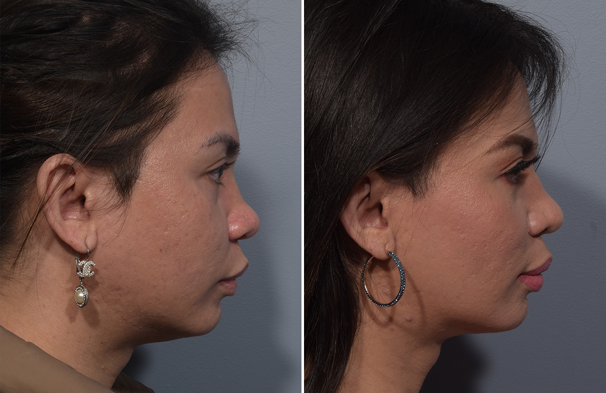 Buccal Fat Removal Before & After Gallery - Patient 578551 - Image 3
