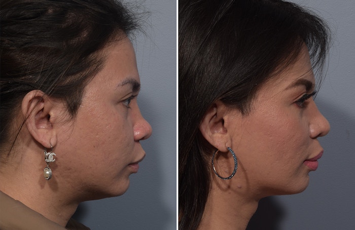 Rhinoplasty Before & After Gallery - Patient 327957 - Image 1