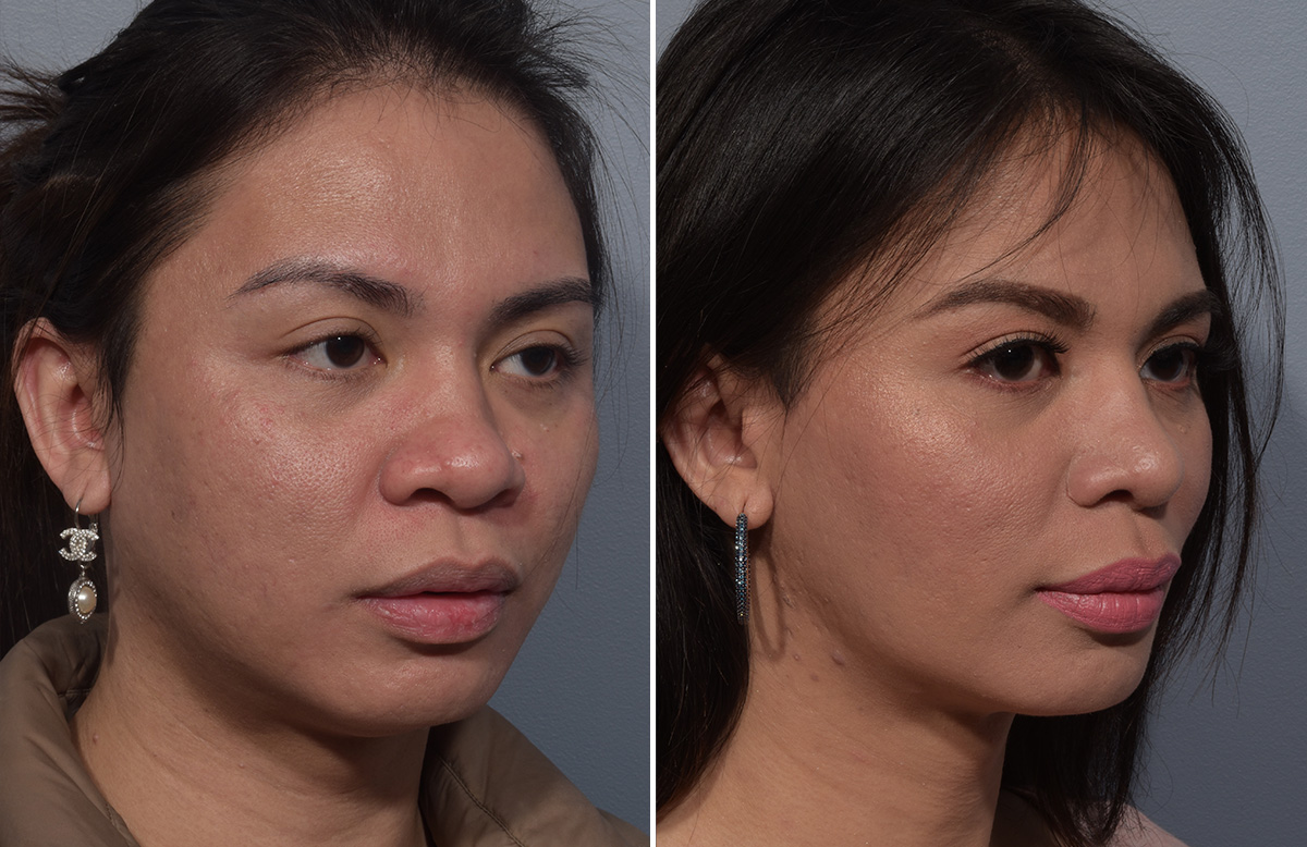 Buccal Fat Removal Before & After Gallery - Patient 578551 - Image 2