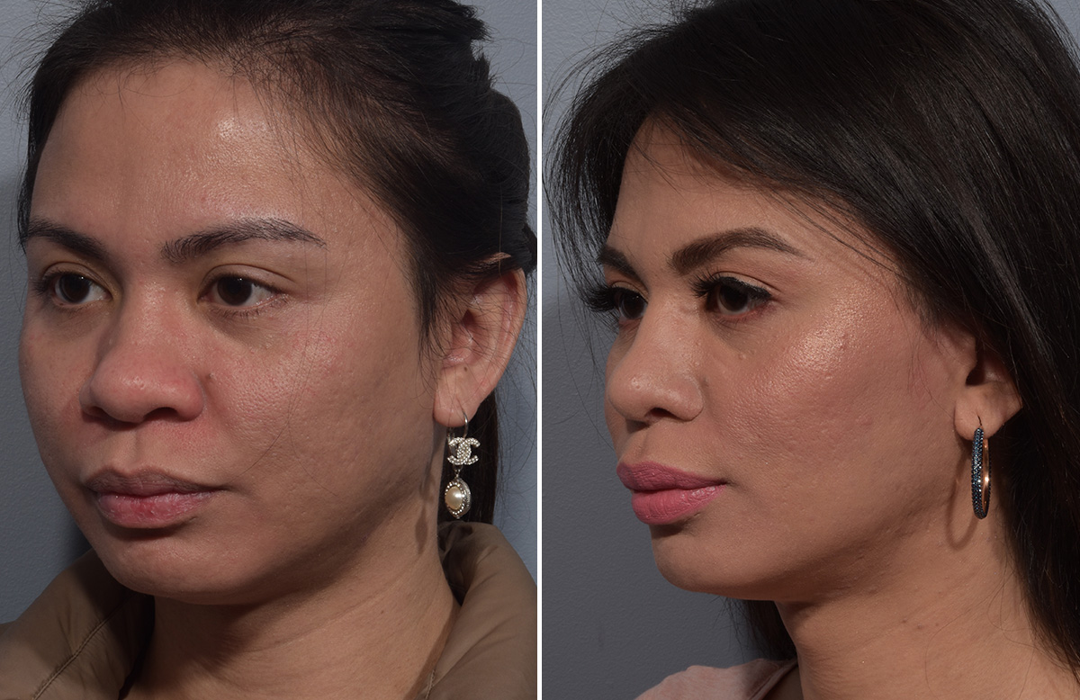 Buccal Fat Removal Before & After Gallery - Patient 578551 - Image 4