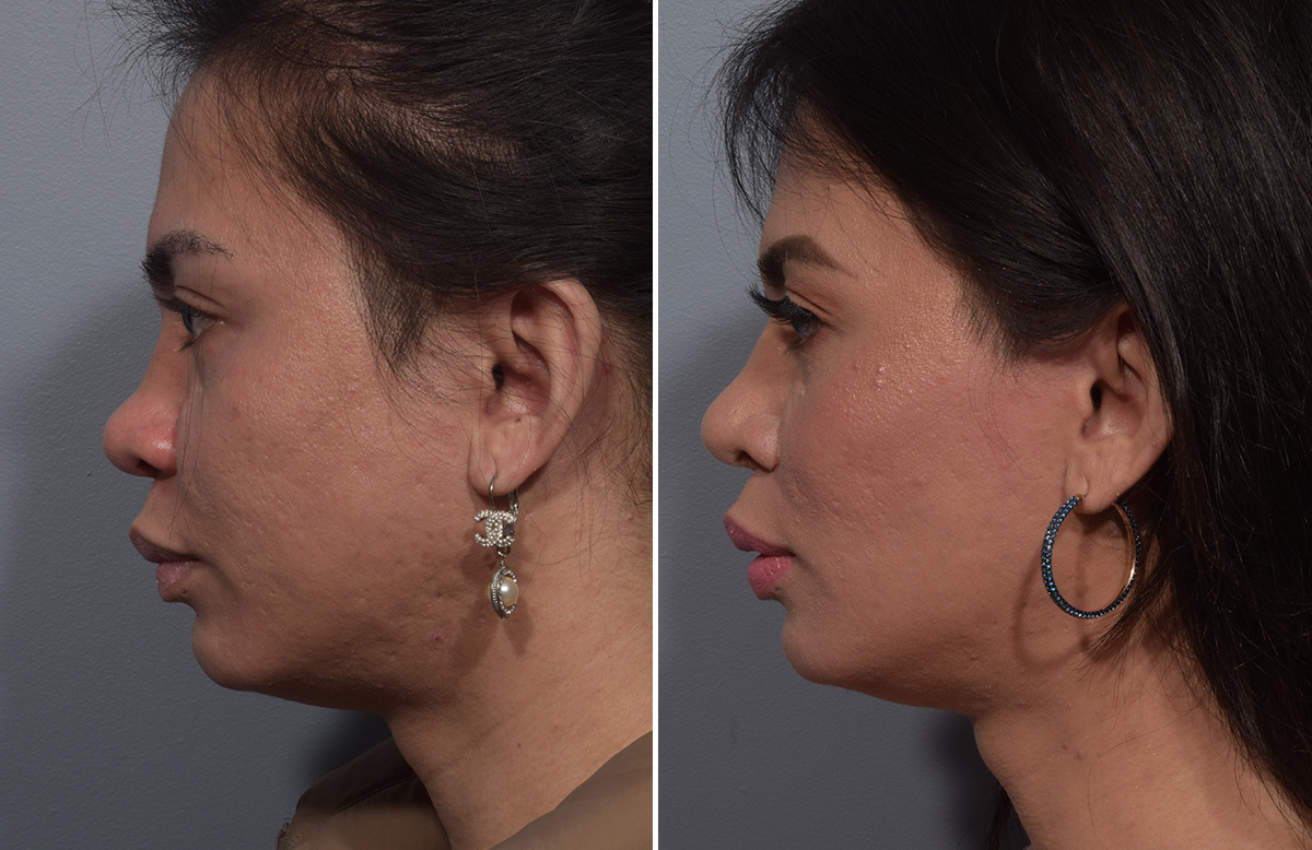 Buccal Fat Removal Before & After Gallery - Patient 578551 - Image 5