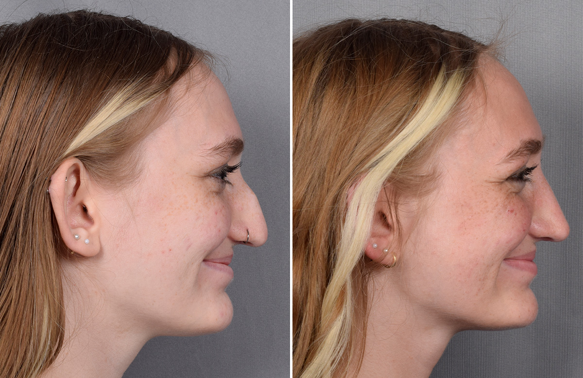 Rhinoplasty Before & After Gallery - Patient 260396 - Image 1