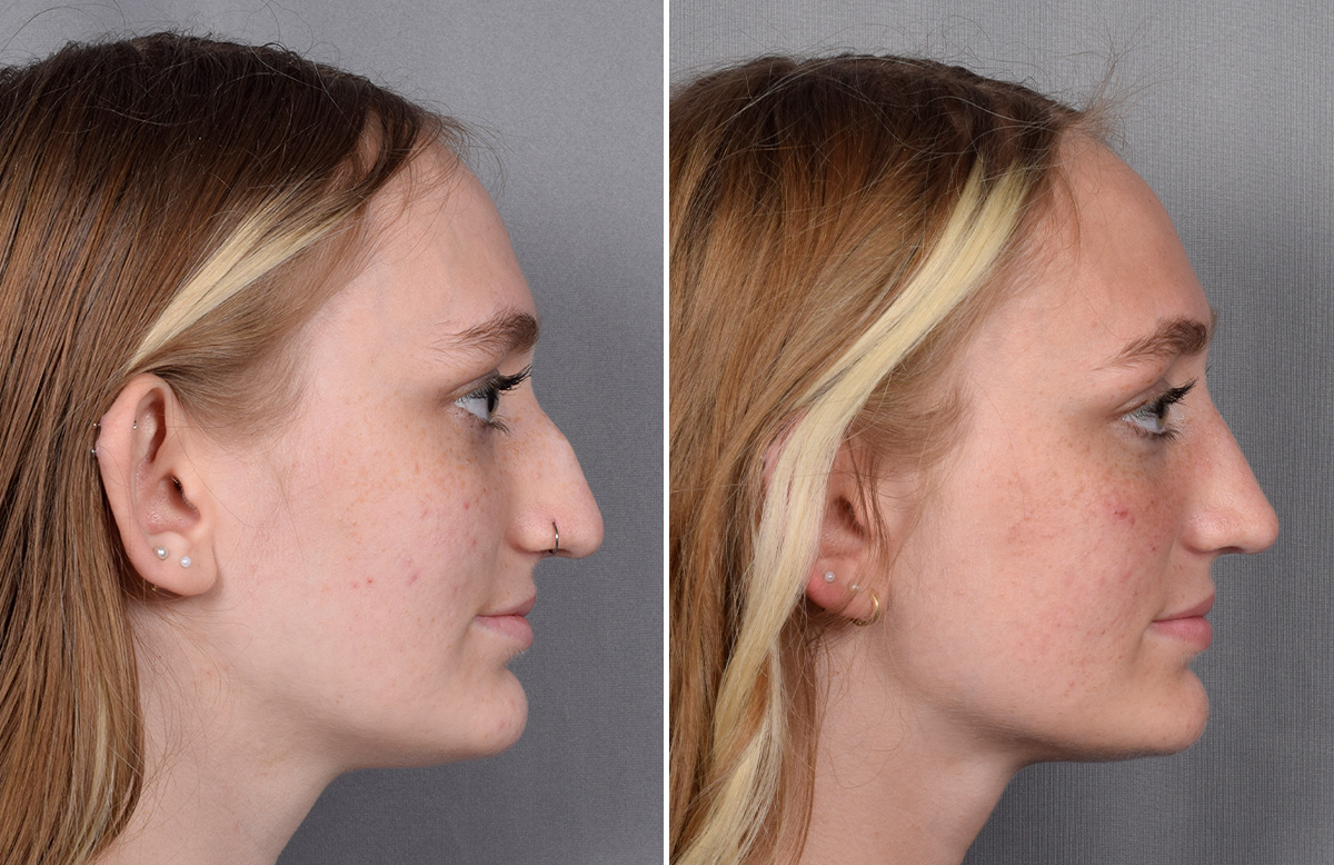 Rhinoplasty Before & After Gallery - Patient 260396 - Image 2