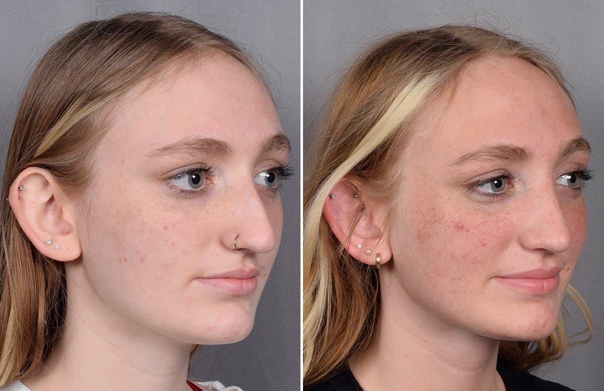 Rhinoplasty Before & After Gallery - Patient 260396 - Image 3