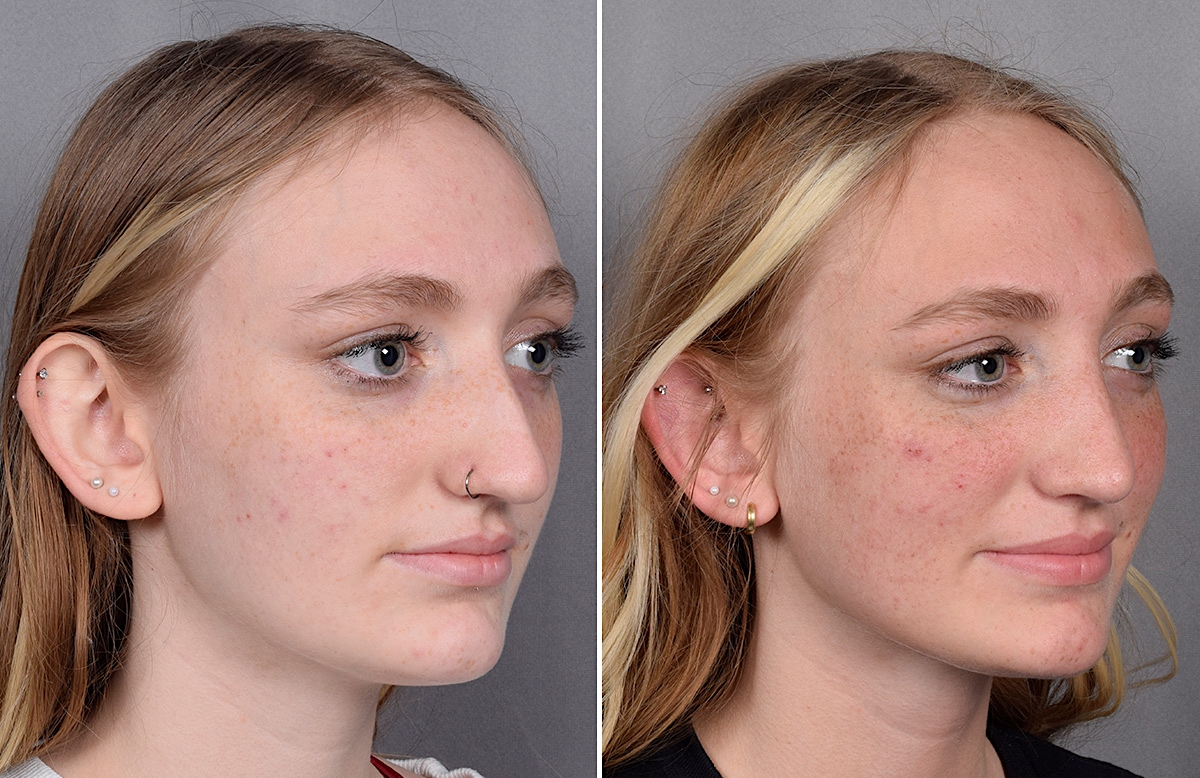 Rhinoplasty Before & After Gallery - Patient 260396 - Image 3