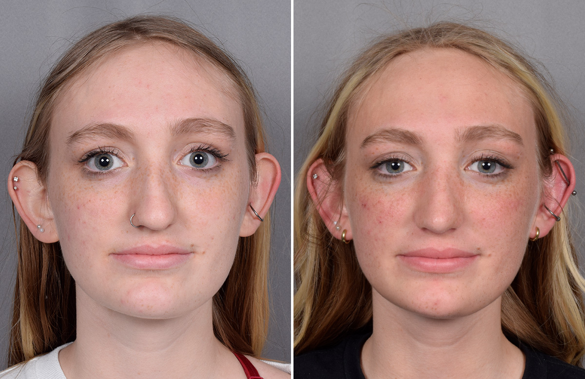 Rhinoplasty Before & After Gallery - Patient 260396 - Image 4