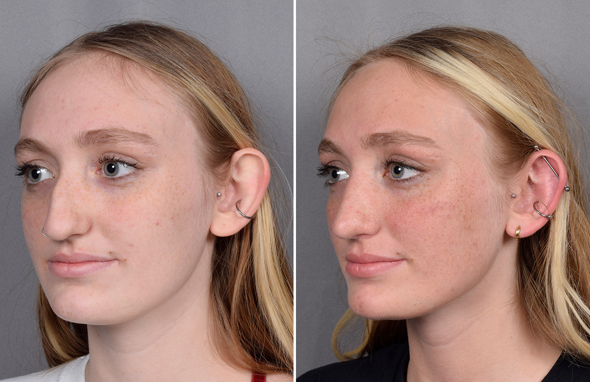 Rhinoplasty Before & After Gallery - Patient 260396 - Image 5