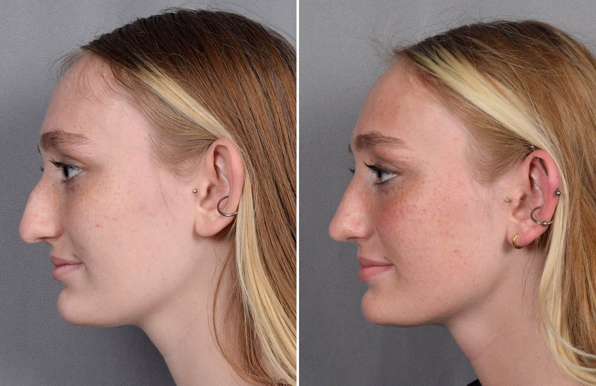 Rhinoplasty Before & After Gallery - Patient 260396 - Image 6