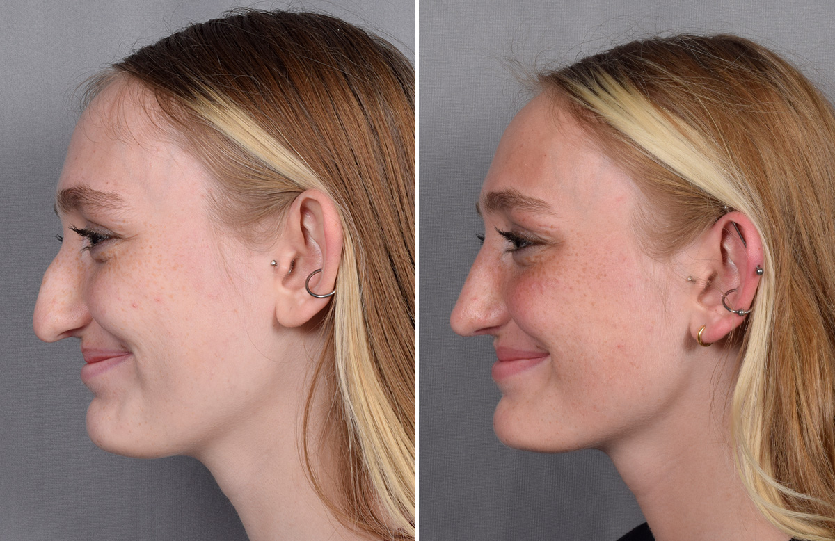 Rhinoplasty Before & After Gallery - Patient 260396 - Image 7