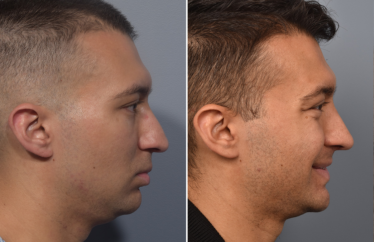 Rhinoplasty Before & After Gallery - Patient 341429 - Image 2