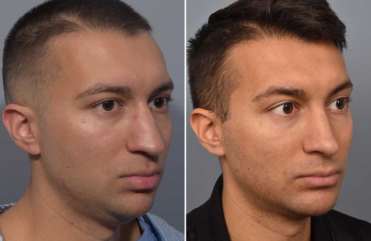 Rhinoplasty Before & After Gallery - Patient 341429 - Image 3