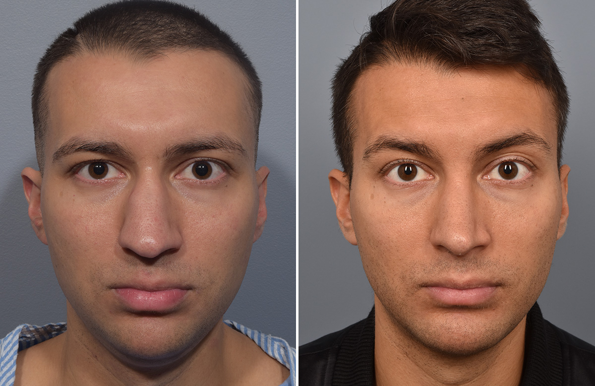Rhinoplasty Before & After Gallery - Patient 341429 - Image 4
