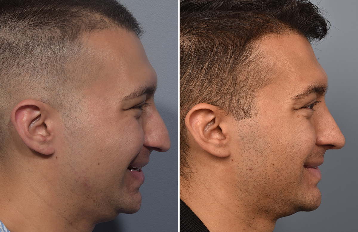 Rhinoplasty Before & After Gallery - Patient 341429 - Image 1